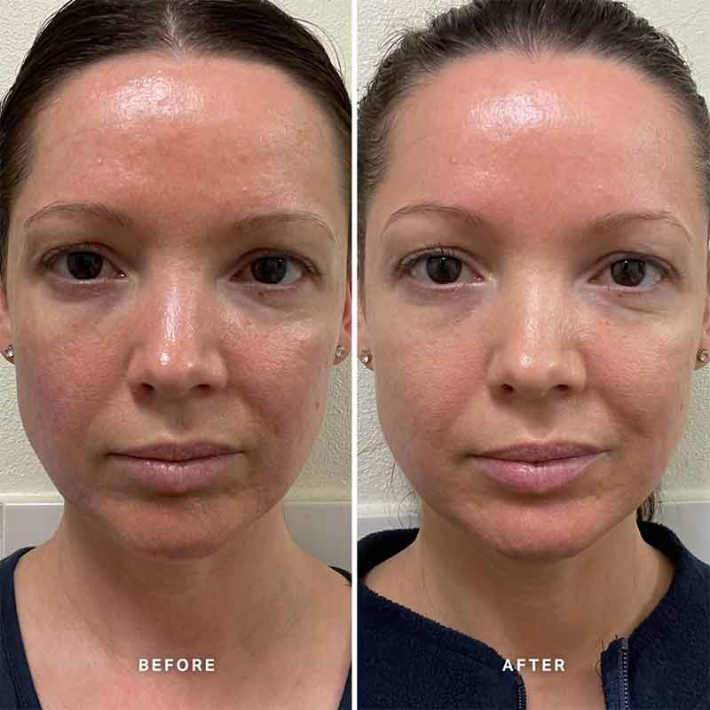 Vitamin B Serum With 5% Niacinamide