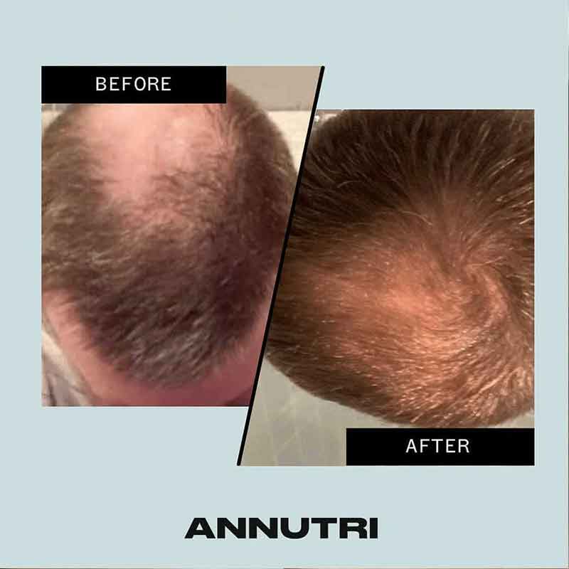 Grow It Hair Growth Supplement 3 Month Supply by Annutri