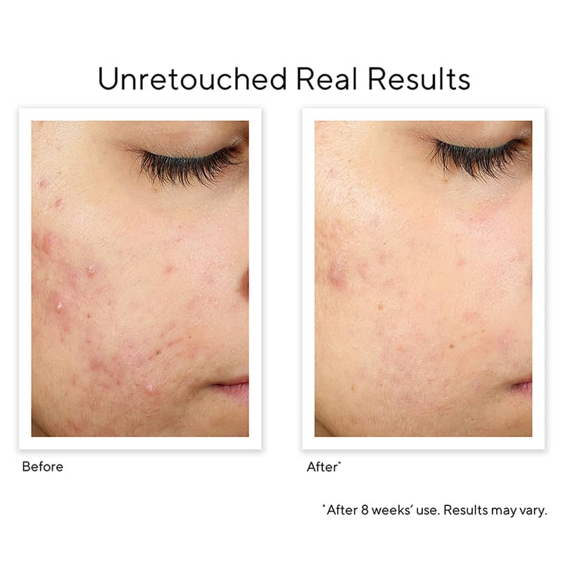 Blemish Control InvisiScar Resurfacing Treatment