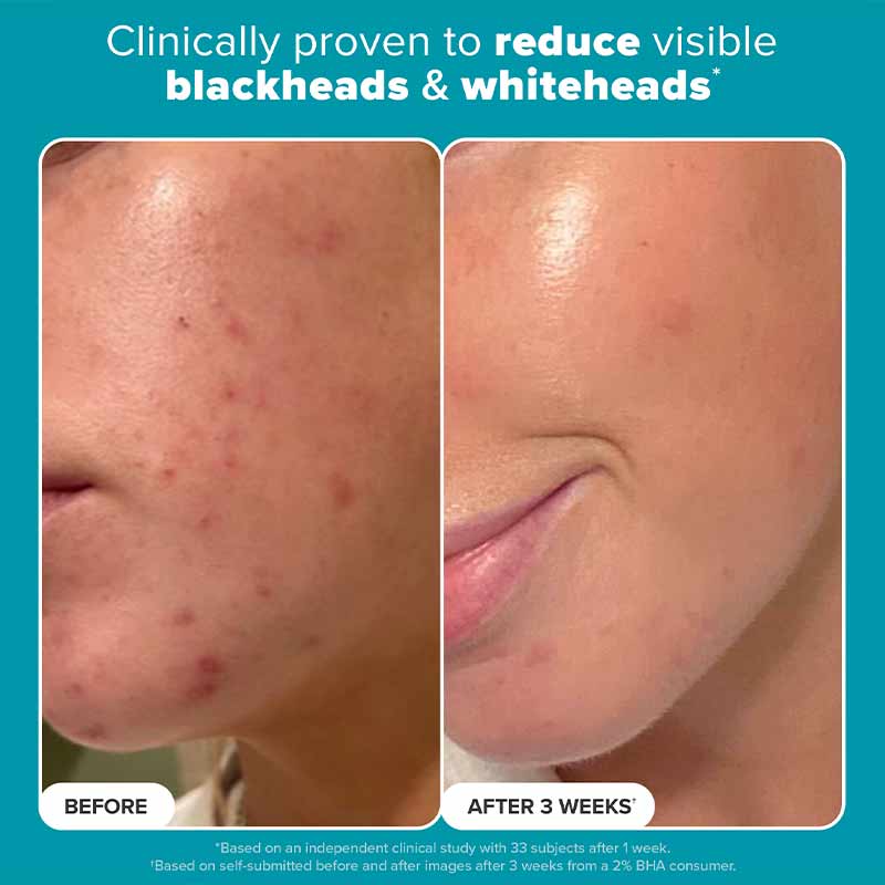Skin Perfecting 2% BHA Exfoliating Toner + Boost 10% Azelaic Acid